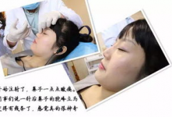 隆鼻视频全过程,隆鼻手术全过程解析